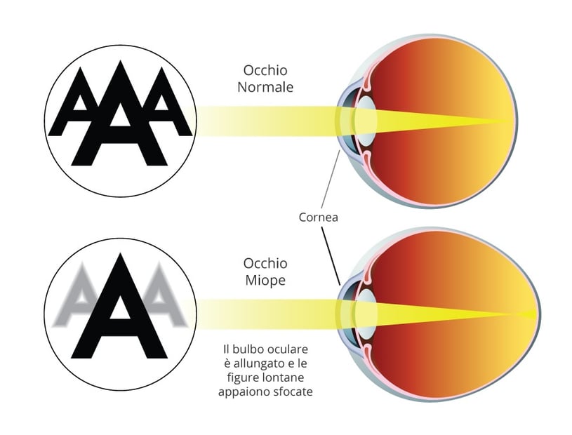 cos'è la miopia - occhio normale e occhio miope