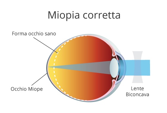 Perché la miopia non si ferma? Ecco le cause del peggioramento