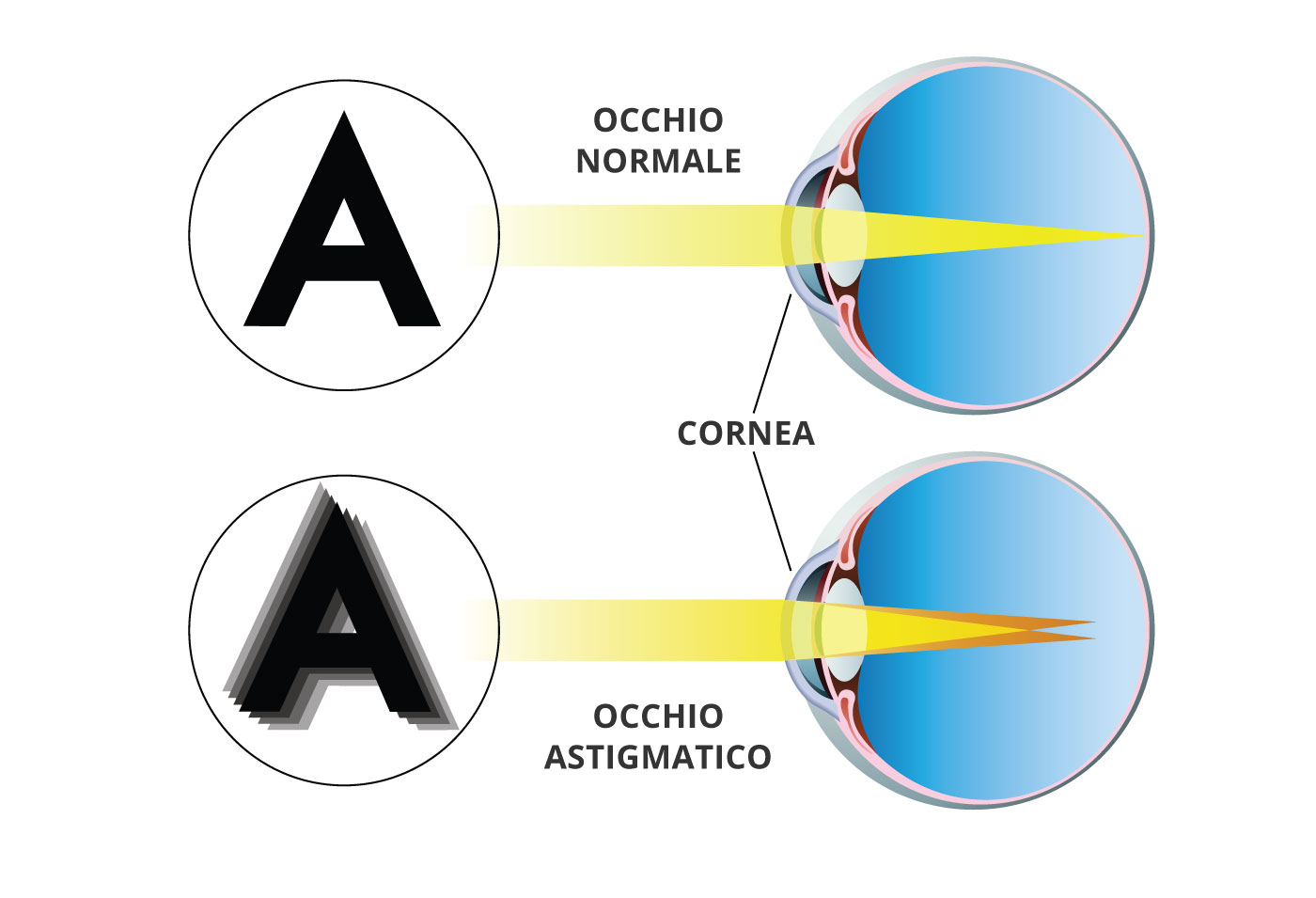 Cos'è l'astigmatismo? Tutti i problemi di questo difetto visivo