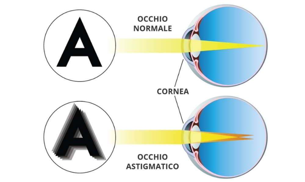 Como se puede corregir el astigmatismo