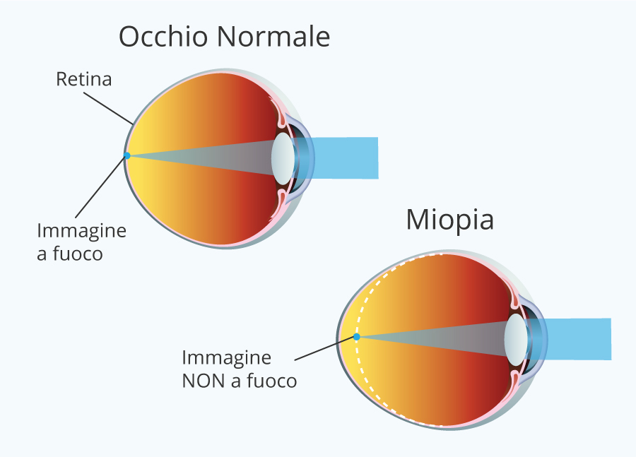 Le cause del peggioramento della miopia