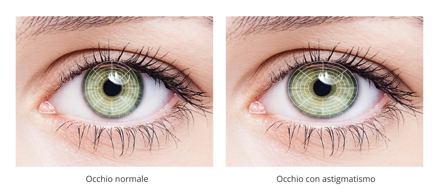 Ciaroni occhio con astigmatismo